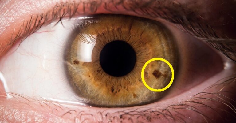 Black Dot in Iris Spiritual Meaning